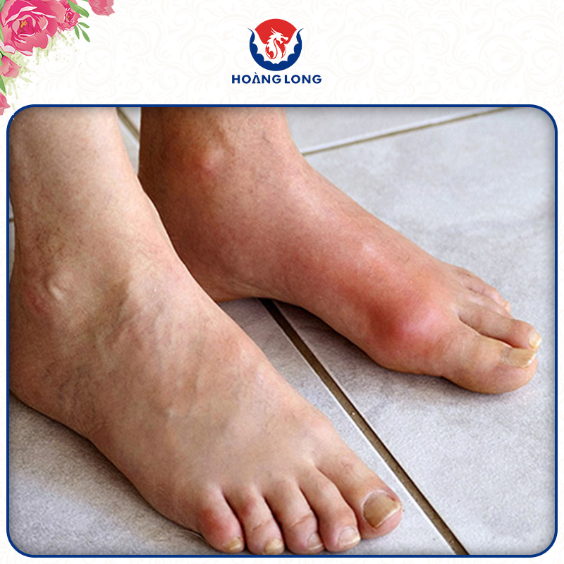 Bệnh gút là gì?