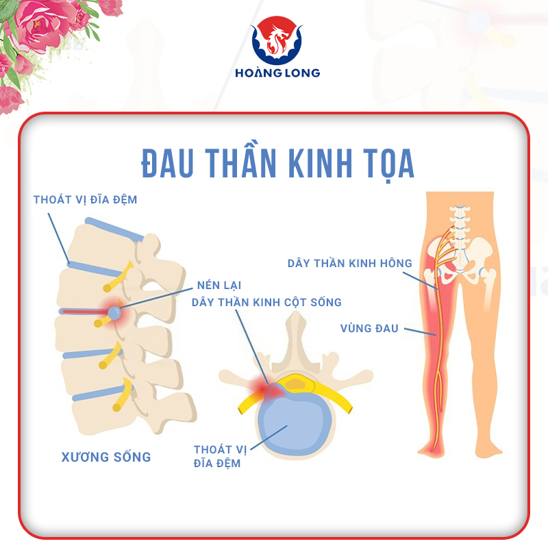 Bệnh đau thần kinh tọa